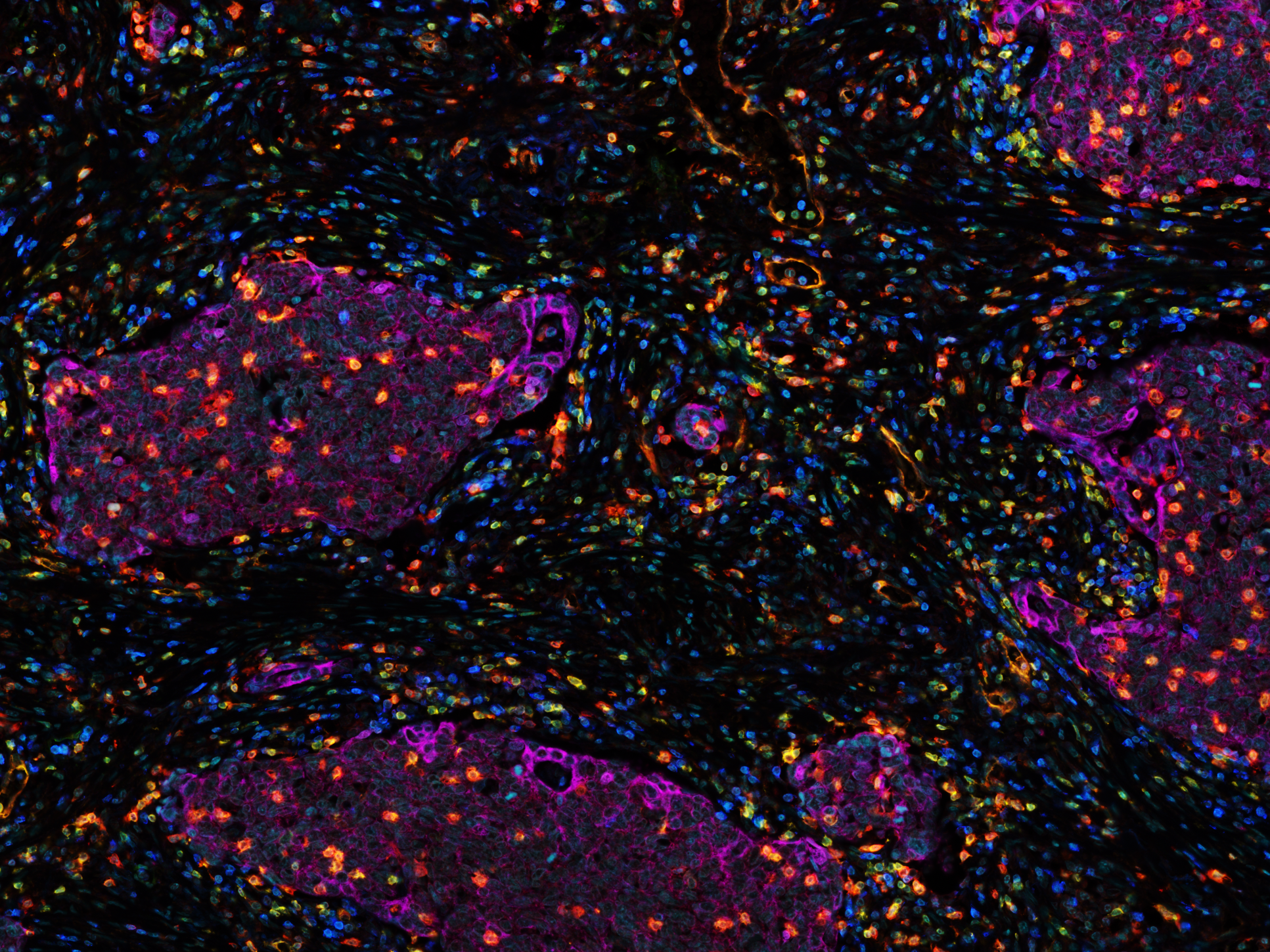 血液細胞に関する洞察が肺がん治療を後押し(Blood cell insights could boost lung cancer therapies)